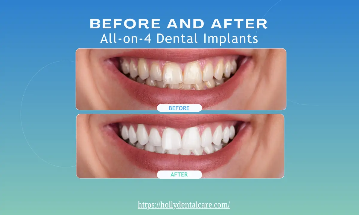 Before and After All-on-4 Dental Implants