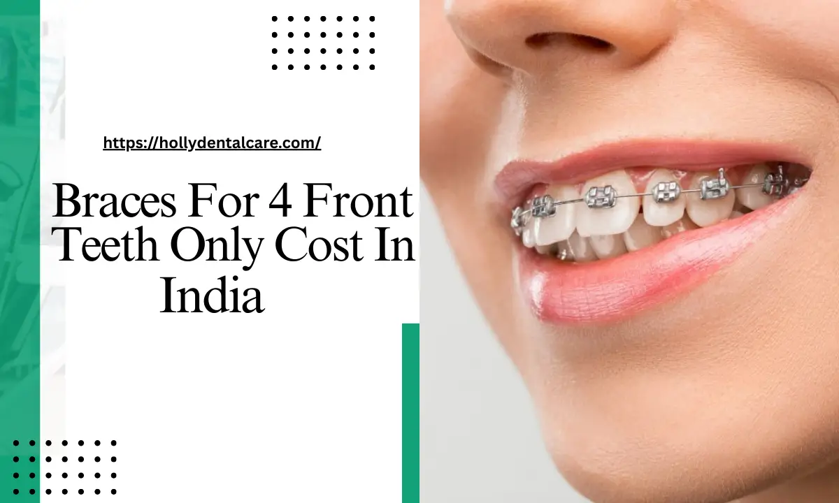Braces for 4 Front Teeth Only Cost in India