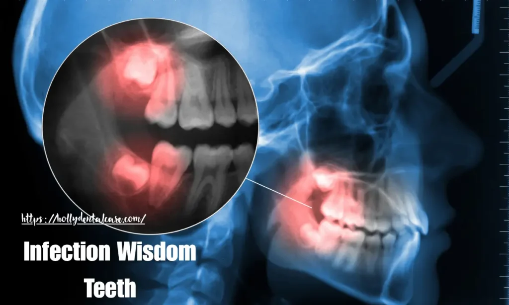 Infection Wisdom Teeth