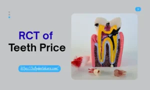 RCT of Teeth Price