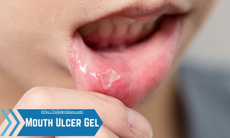 Mouth Ulcer Gel